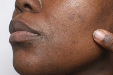 Dunkle Haut mit sichtbaren Pigmentflecken, Finger zeigt auf betroffene Gesichtsregion