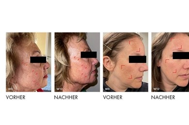 Vorher-Nachher-Bilder dokumentieren sichtbare Verbesserung der Hautstruktur nach zwölf Wochen