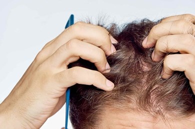 Types de chute de cheveux